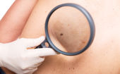 ABCDE: Pět písmen pomůže s odhalením rakoviny kůže