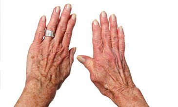 Biologická léčba – další možnost, jak léčit revmatoidní artritidu