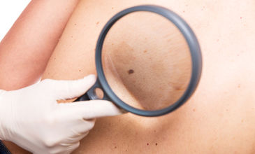 ABCDE: Pět písmen pomůže s odhalením rakoviny kůže