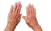 Biologická léčba v terapii revmatoidní artritidy slibuje mocnější ovlivnění nemoci