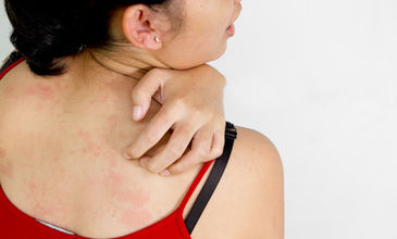 Vedlejší účinky biologické léčby často postihují kůži